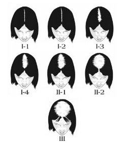 Female-Pattern Hair Loss | Hair Transplant Vegas - Henderson, NV