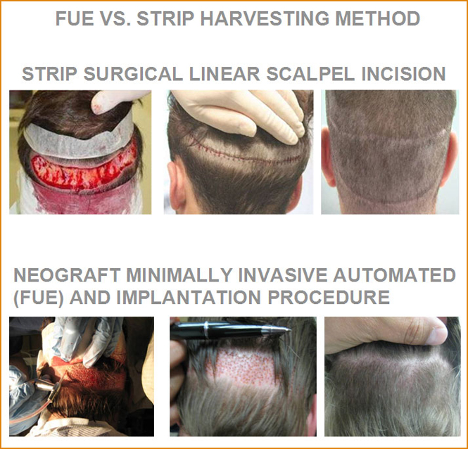 Traditional Hair Transplant vs. NeoGraft - Las Vegas NV