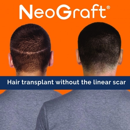 neograft no scar 0