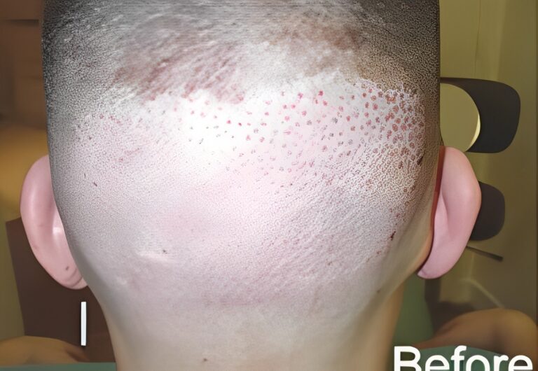 Before Image: Patient 6 - back