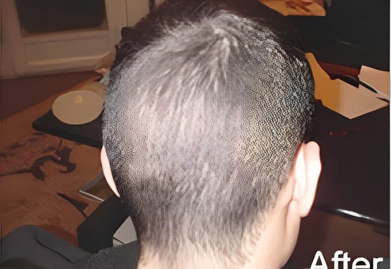 After Image: Patient 6 - back