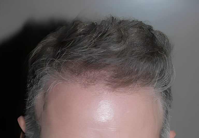 After Image: Patient 1 - front