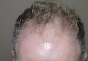 Before Image: Patient 1