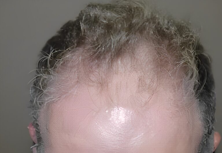Before Image: Patient 1 - front