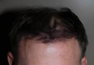 After Image: Patient 2