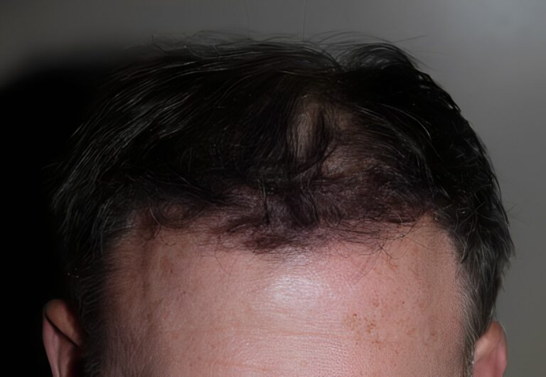 After Image: Patient 2 - front