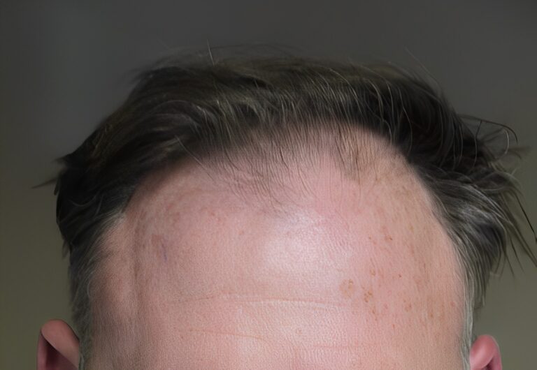 Before Image: Patient 2 - front