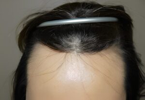 Before Image: Patient 3