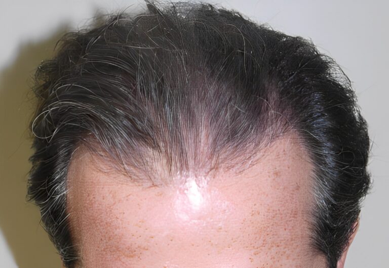 After Image: Patient 4 - front