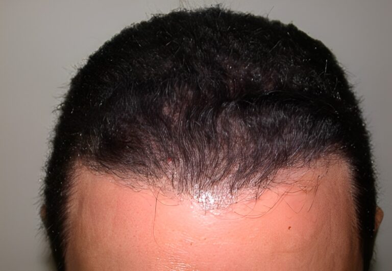After Image: Patient 5 - front