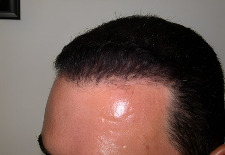 After Image: Patient 5 - left-front-oblique