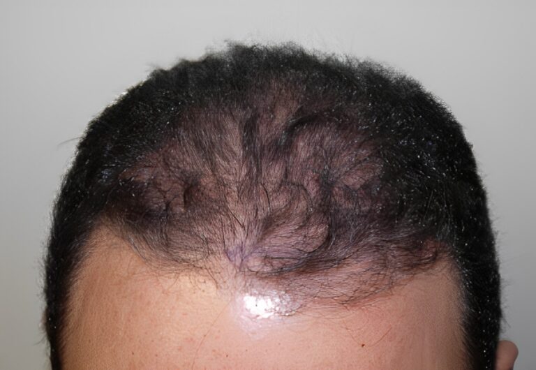 Before Image: Patient 5 - front