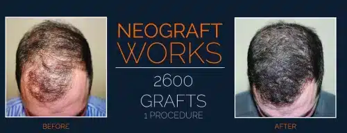 neograft-ba-pic.jpg neograft ba pic.jpg
