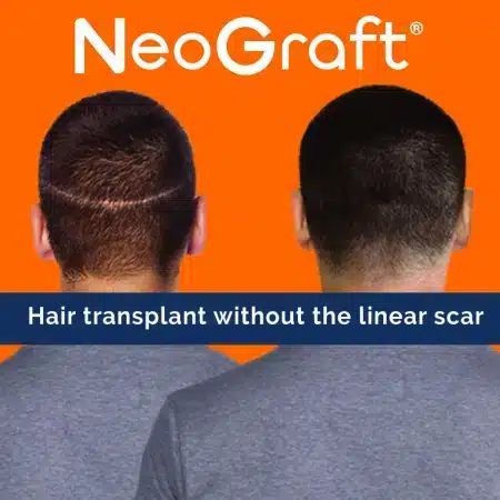 neograft-no-scar_0.jpg neograft no scar 0.jpg